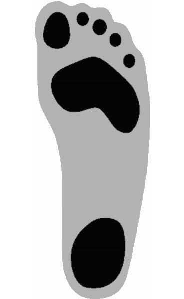 Fußabdruck - Ein Hohlfuß ist durch eine sehr hohe Fußwölbung gekennzeichnet. Dabei stehen die Ferse und der Vorderfuß unter starker Belastung, während der mittlere Bereich des Fußes kaum Kontakt zum Boden hat.