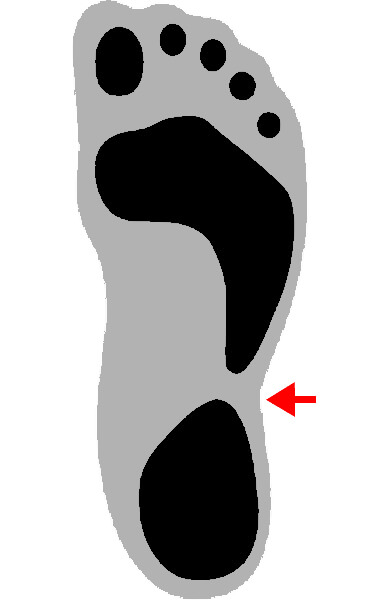 Fußabdruck - Ein Knickfuß ist gekennzeichnet durch eine deutliche Senkung des Längsgewölbes des Fußes. Dadurch entsteht eine starke Belastung auf den inneren Fußrand und die Knöchelregion.