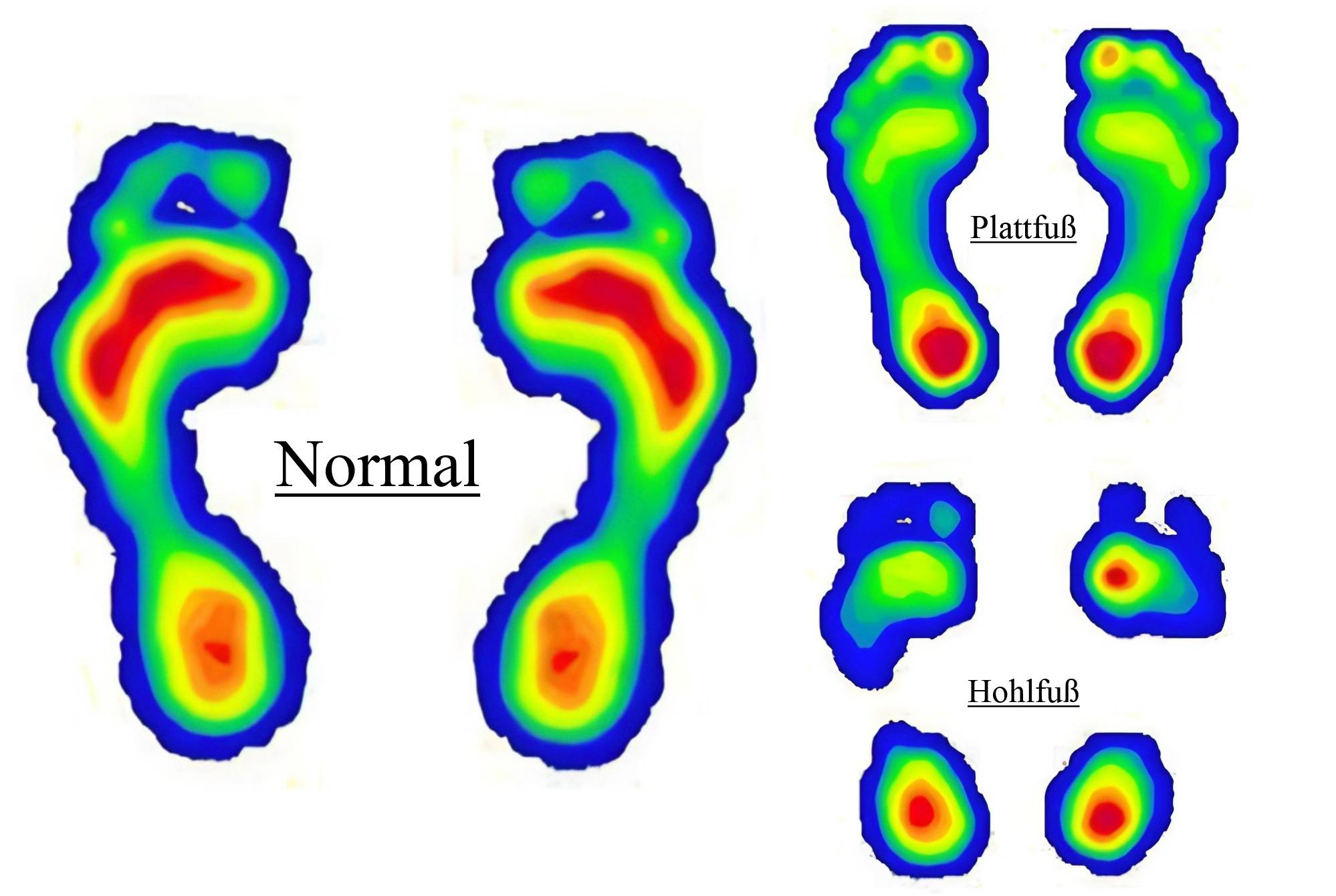 Normal Fuß Plattfuß Hohlfuß