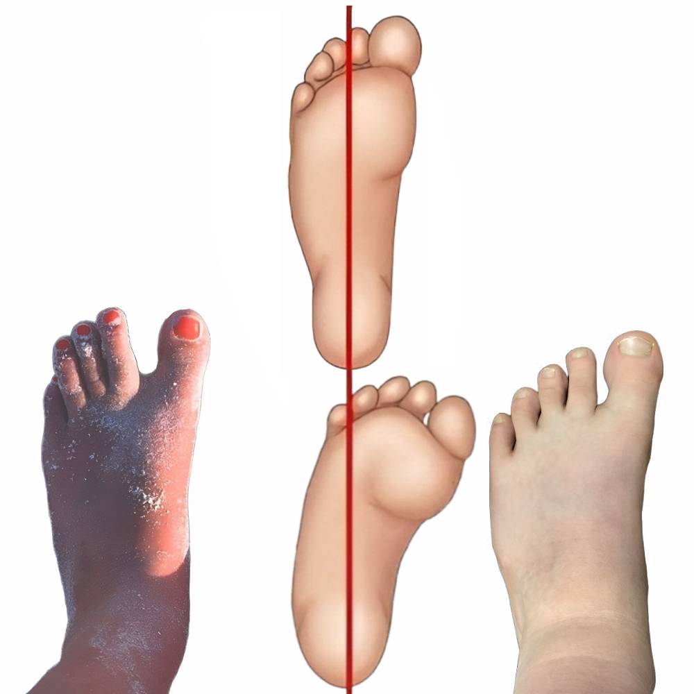 Pes adductus und Normal Fuß