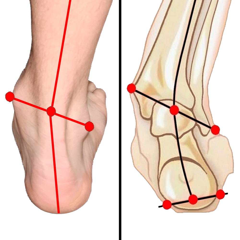 Diagnose - Knickfuß