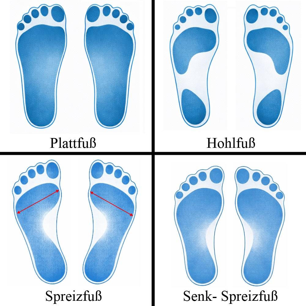 Vier Verschieden Fußfehlstellungen