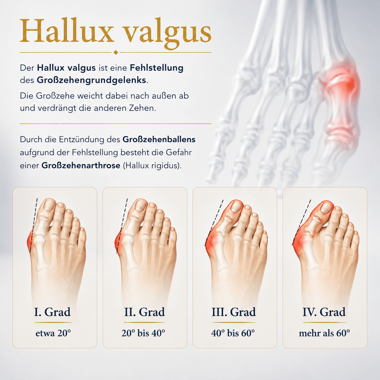 Grafik zum Hallux valgus mit Erklärung der Fehlstellung des Großzehengrundgelenks und Darstellung der Schweregrade I bis IV.