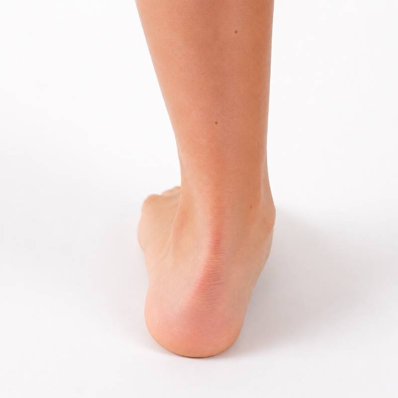 Rückansicht eines Knickfußes mit nach innen geneigter Fersenstellung als Beispiel für einen Senk-Knickfuß.